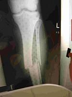 NEW*  Bat's one-piece overlays (On Brickyard)-mini-fractured-tibia-and-fibula-aug-17-2003.jpg